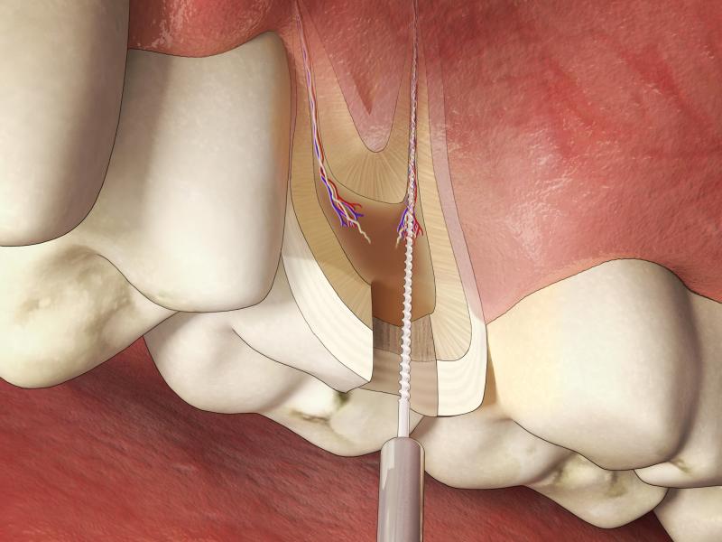 Traitement des caries : la dévitalisation des dents par traitement du canal radiculaire
